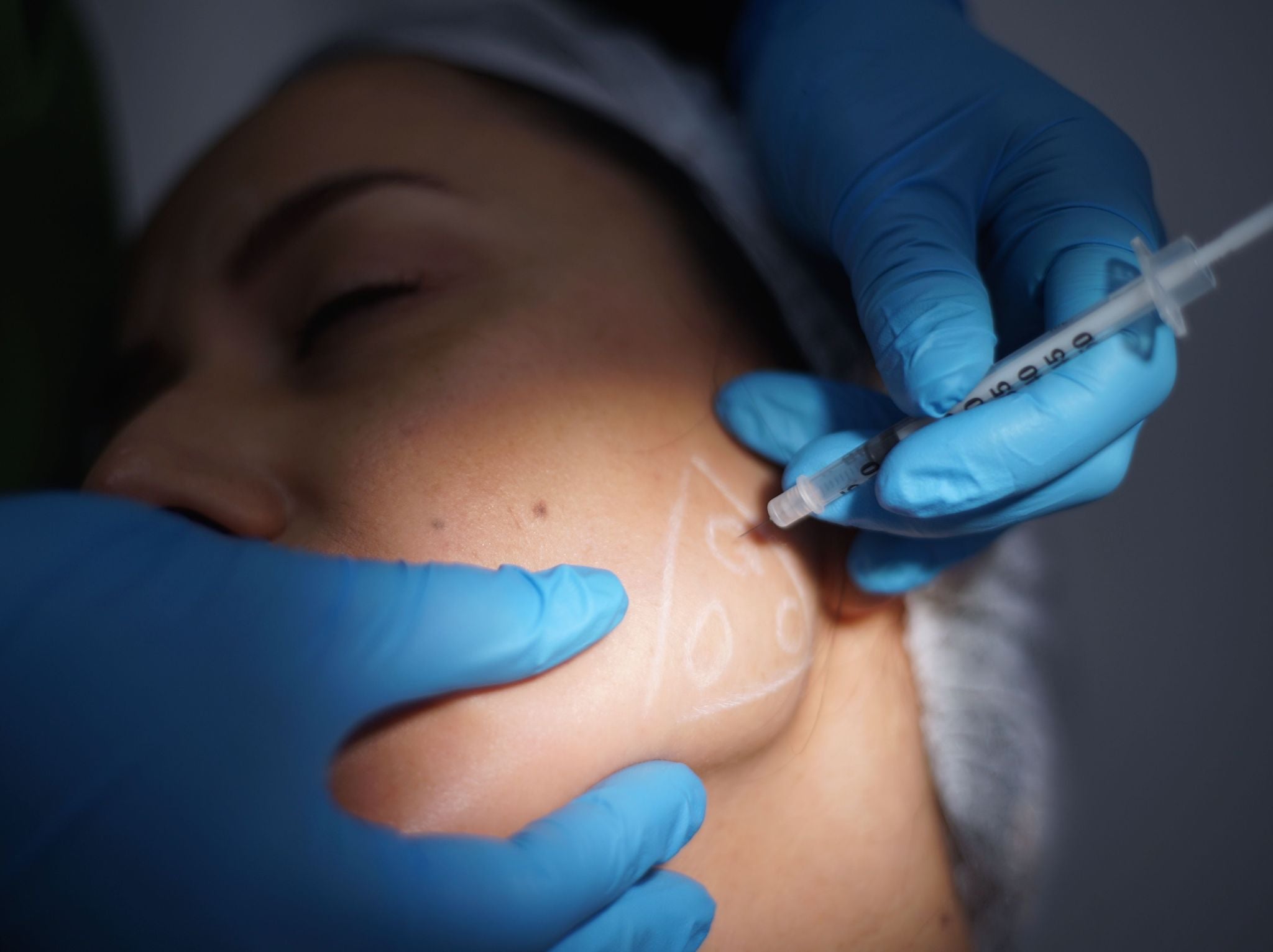 Masseter Botox was a last resort but it did seem to work